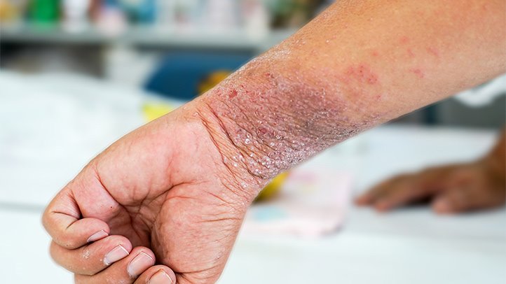 Is Eczema itchy?
