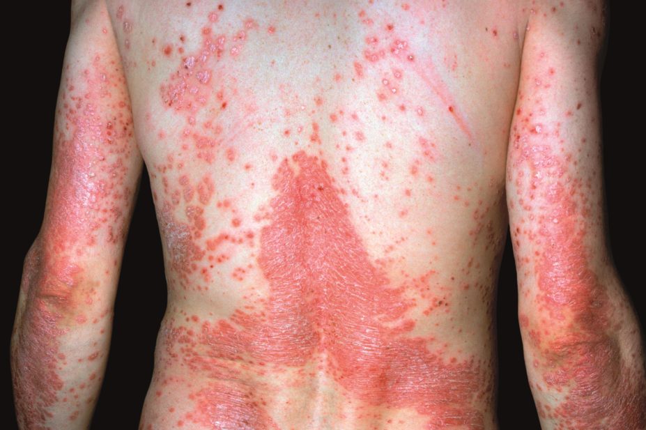 Is it possible to cure psoriasis without taking drugs?