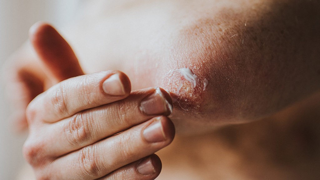 The Difference Between Topical And Systemic Psoriasis Treatments