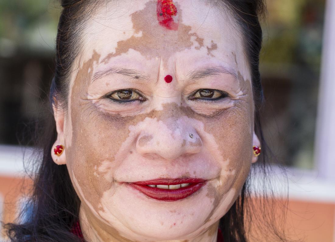 The difference between Vitiligo and other skin conditions