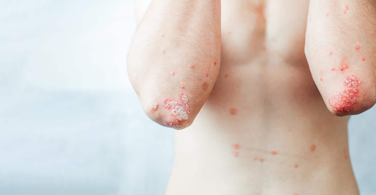 The different factors that affect the speed of homeopathic psoriasis treatment