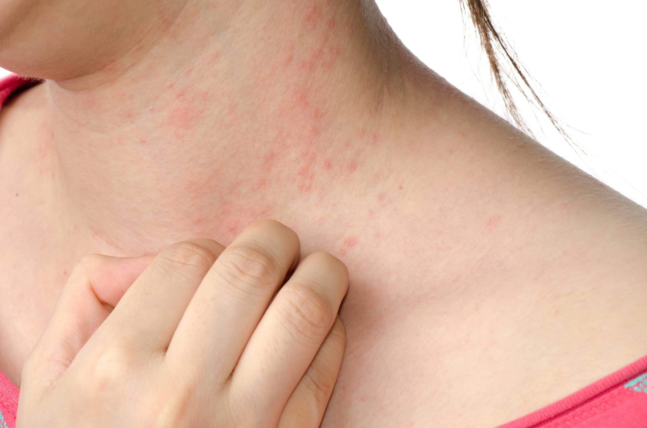 Top 10 Most common eczema treatments