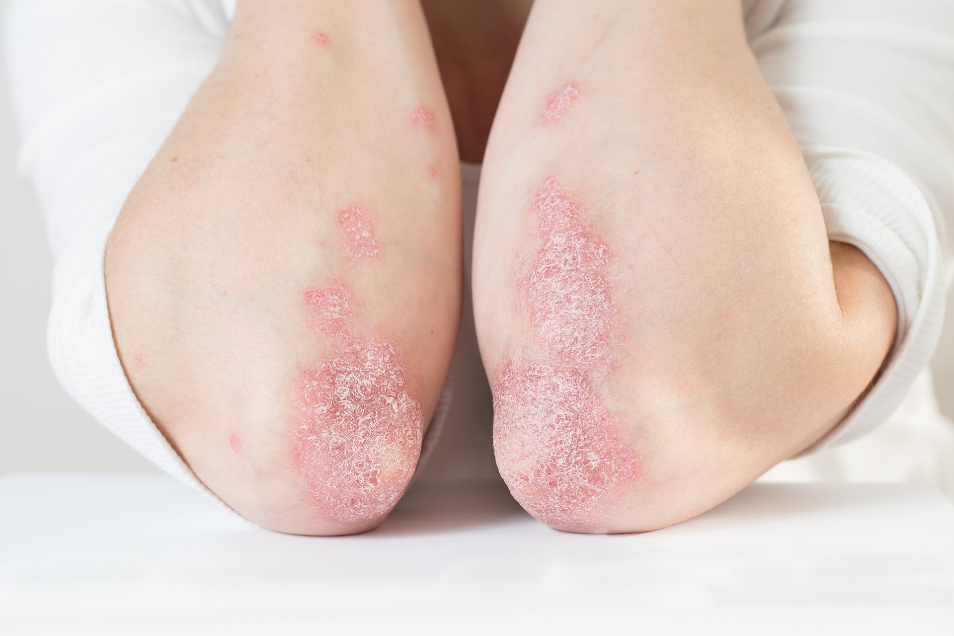 Understanding And Managing Psoriasis In Different Age Groups