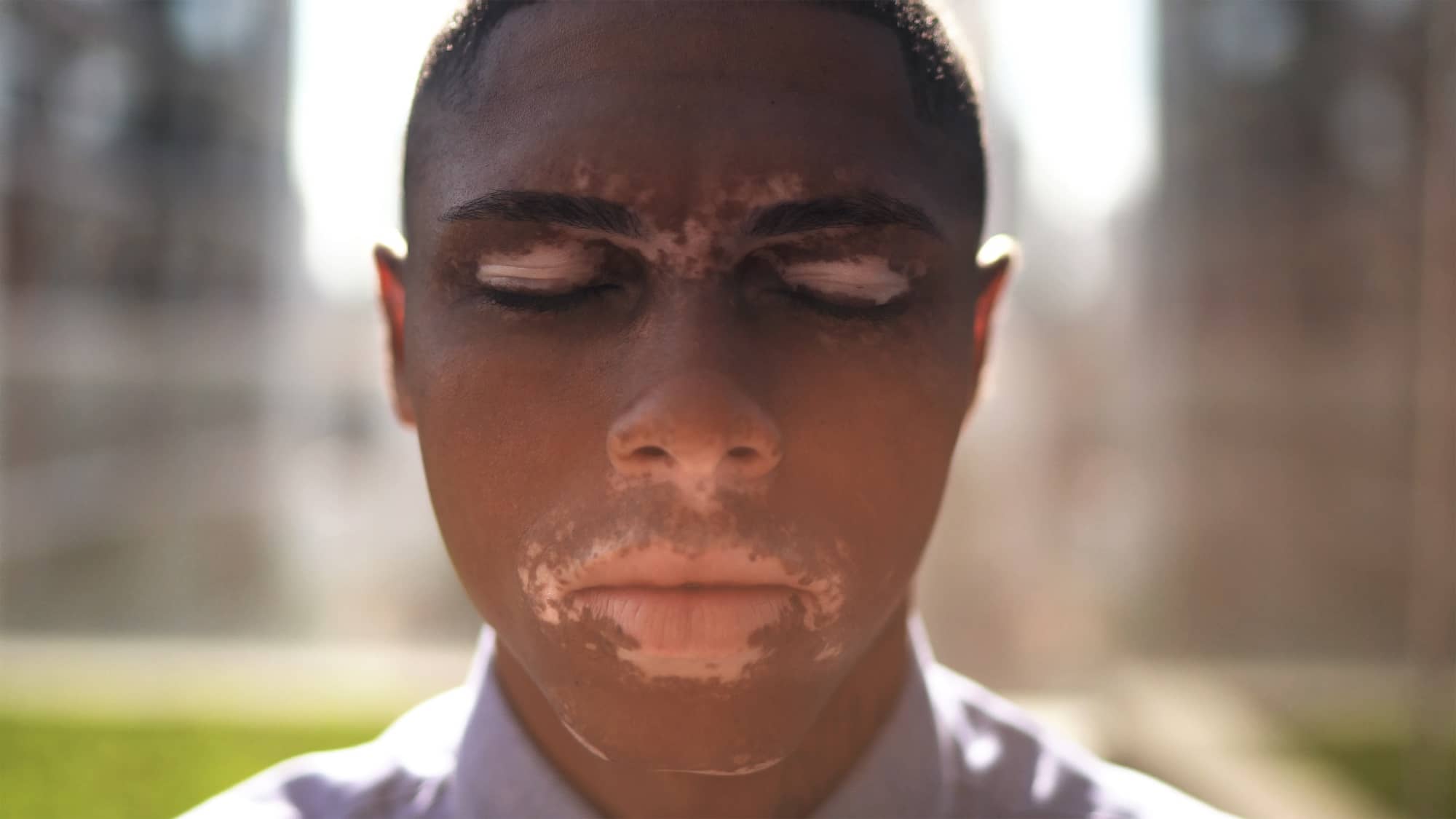 Untreated or treated vitiligo
