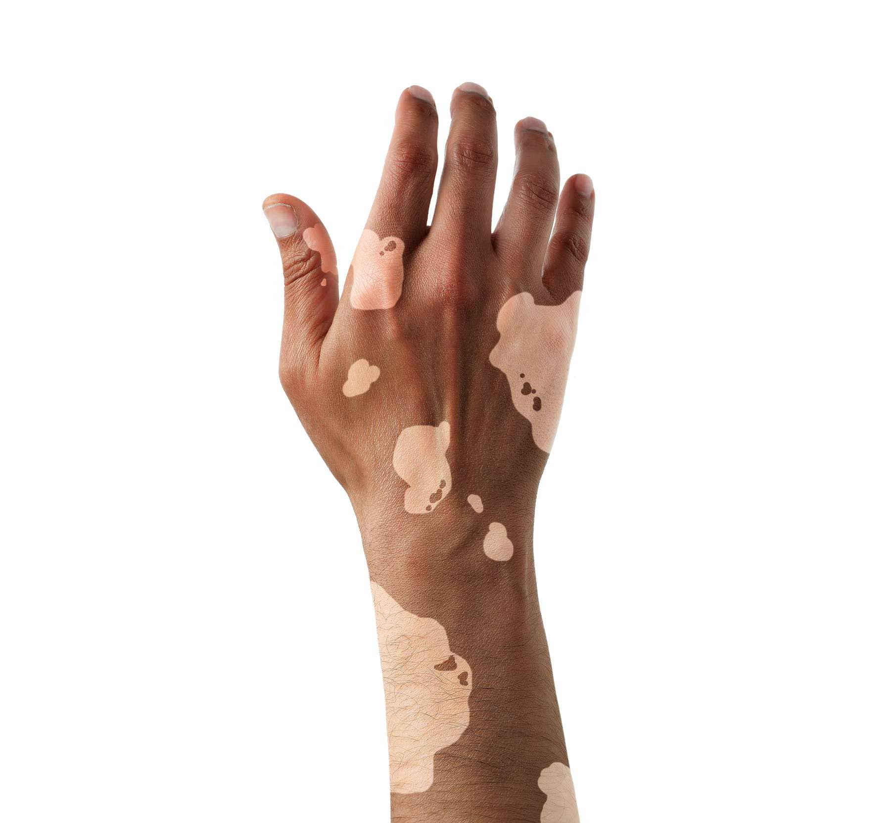 Vitiligo: A comprehensive guide