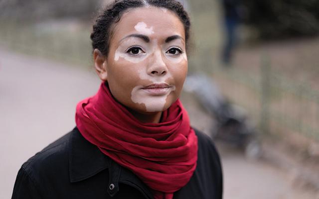 When to see the doctor for vitiligo?