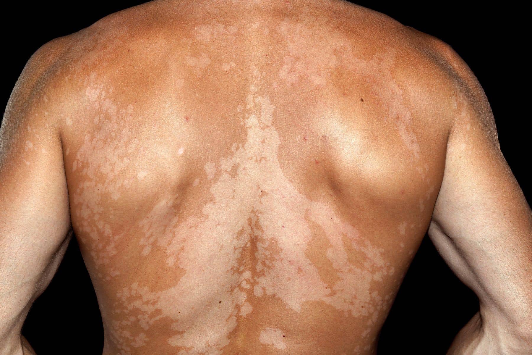 What Are The Common Conditions That White Patches Can Be A Symptom Of?