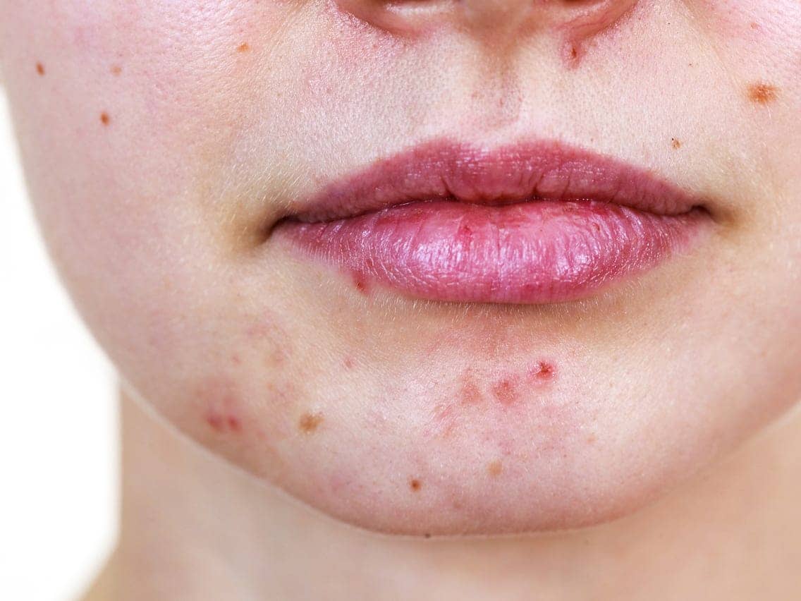 What Are The Prime Causes Of Acne?