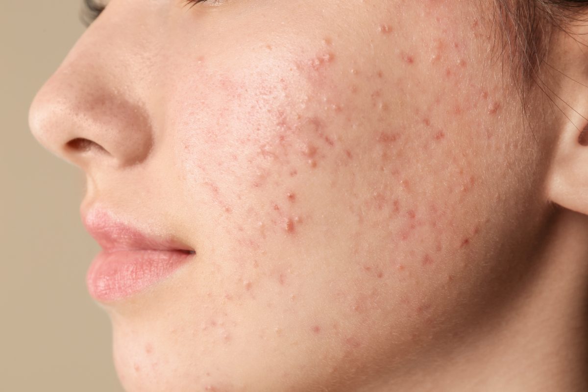What Are The Signs Of An Acne Breakout?