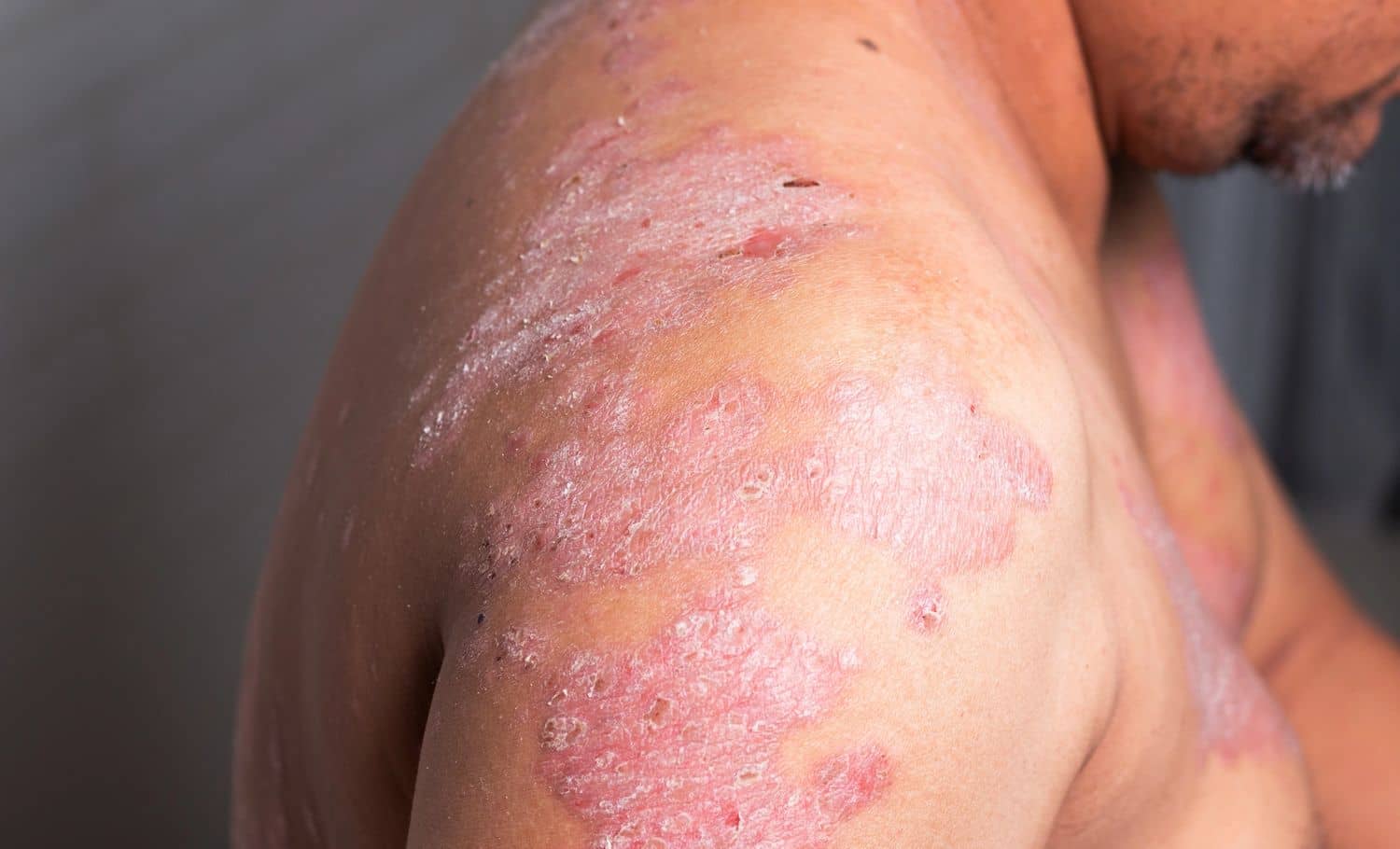 Why Is Psoriasis On The Rise?