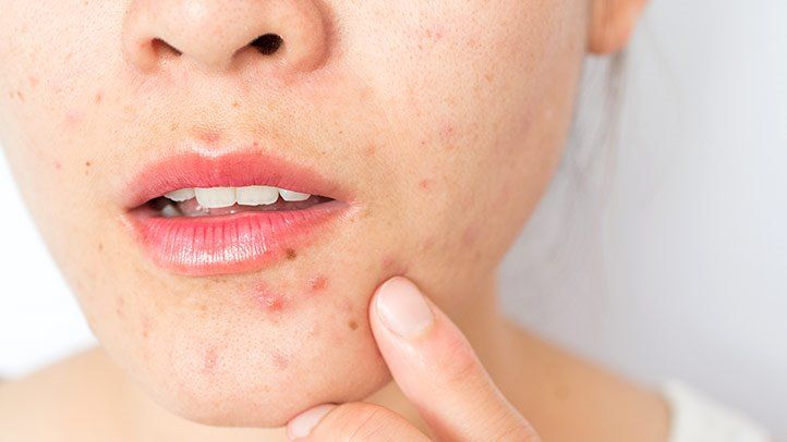 10 Practical Ways To Get Rid Of Acne Without Going Under The Knife