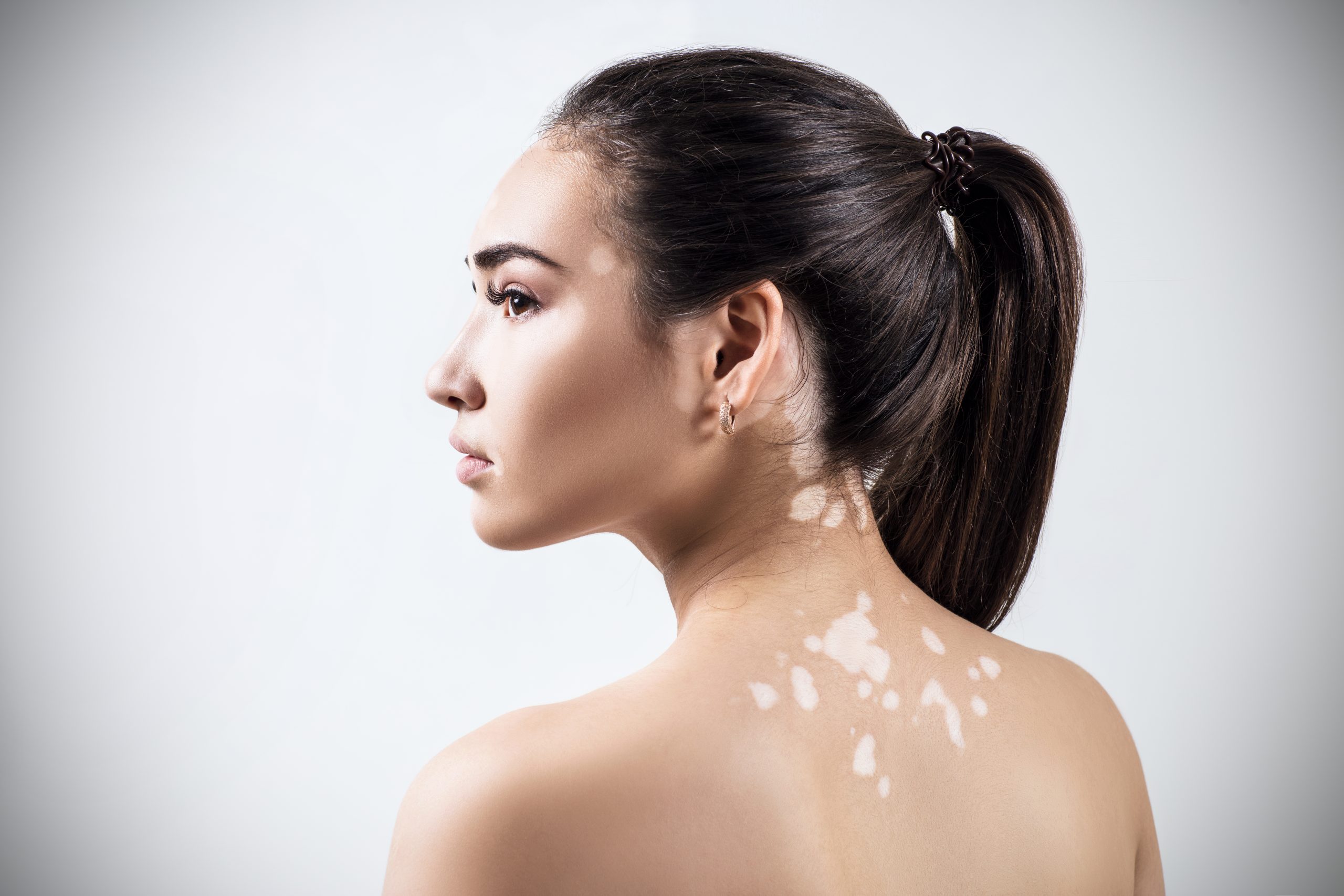 Can Vitiligo be cured in the early stages?