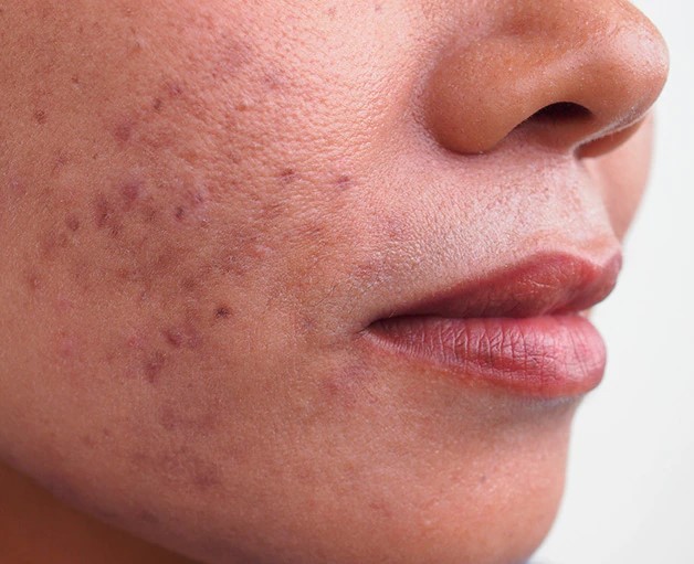 How Do I End My Continuous Search For Perfect Acne Treatment?
