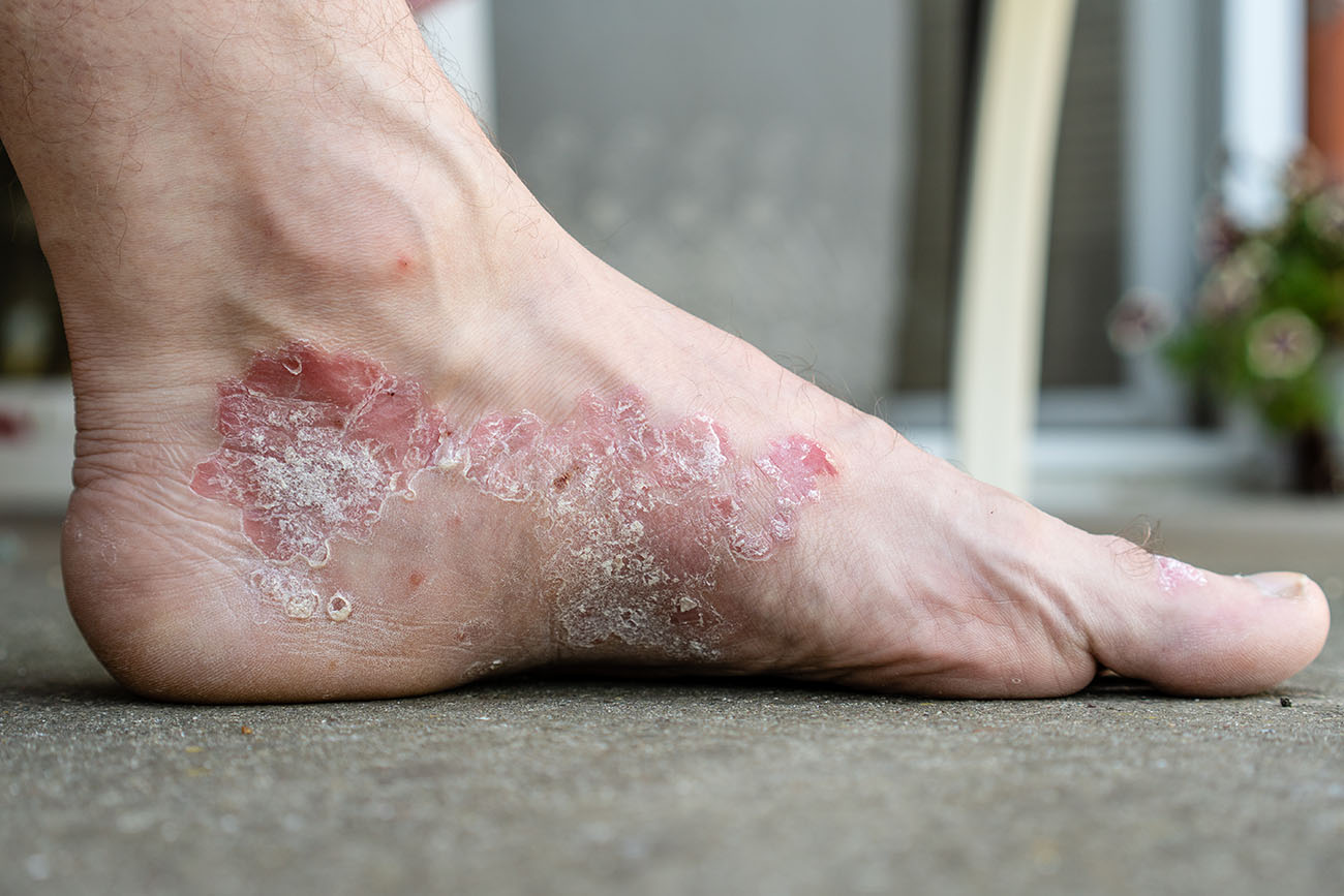 Psoriasis & Homeopathy: A Match Made In Heaven