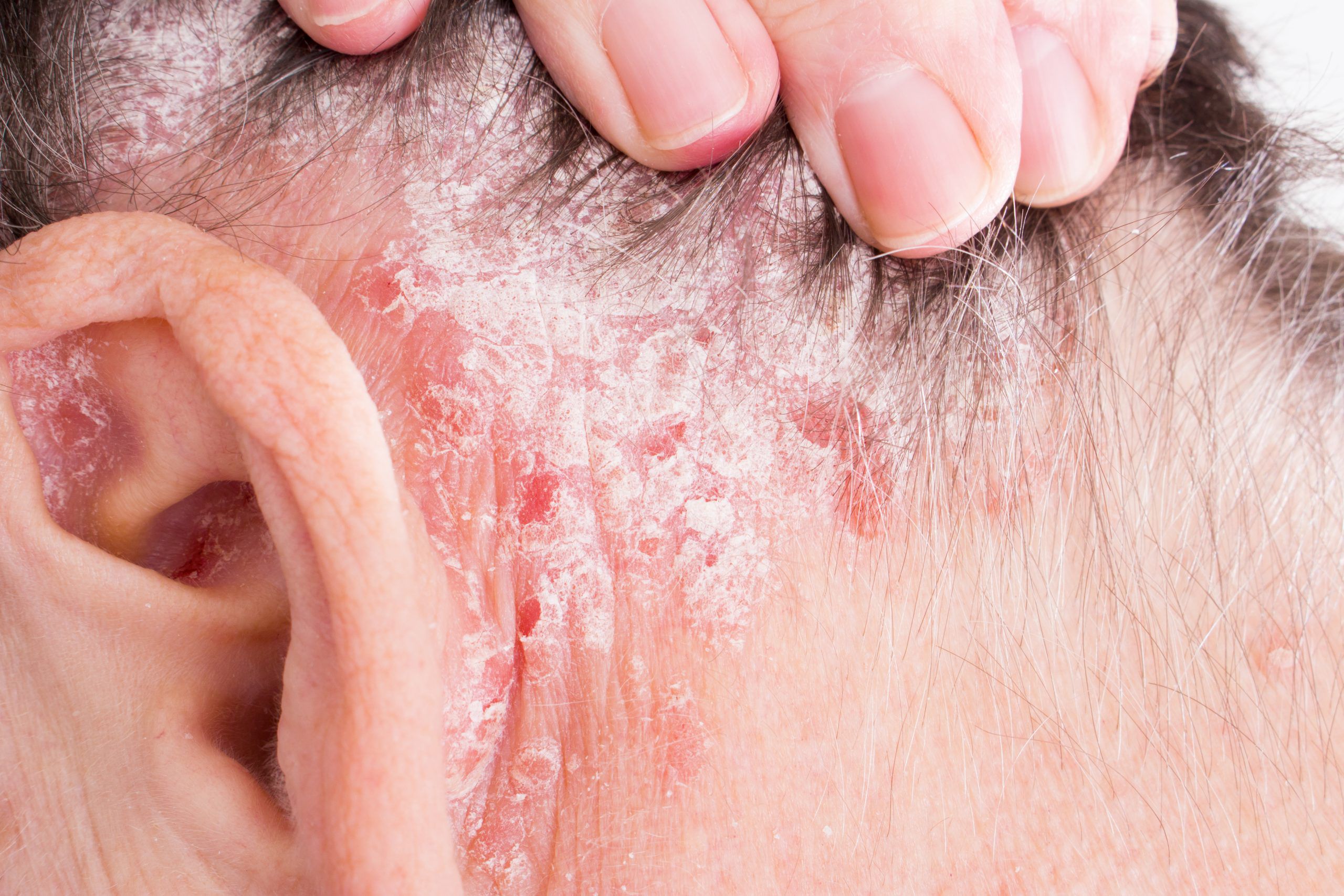 Psoriasis-how it affects the mind, marital life, and social life of patients?