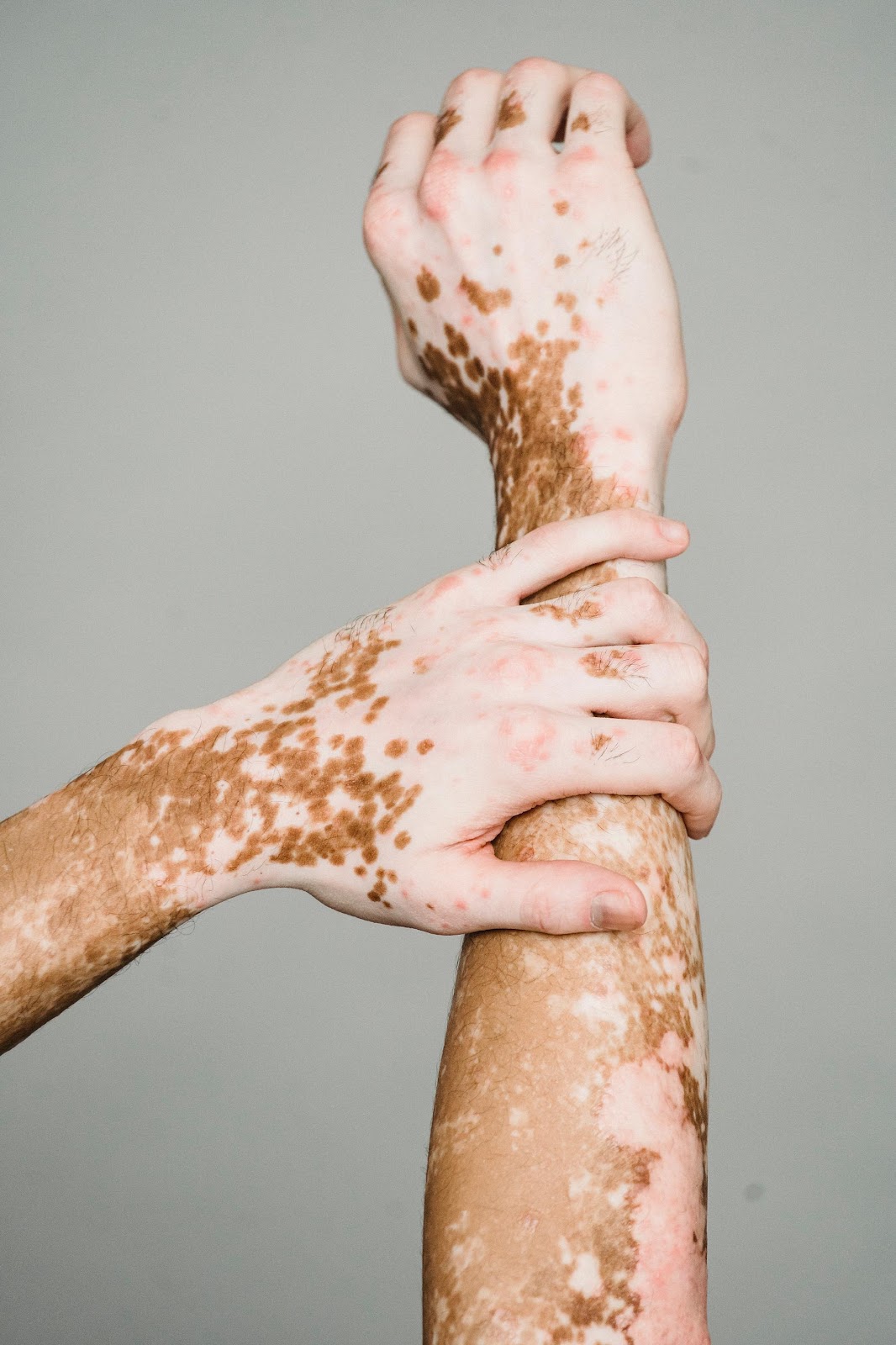 Signs that vitiligo is spreading to other parts of your body