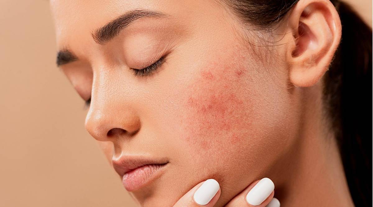 What are the different types of pimples?