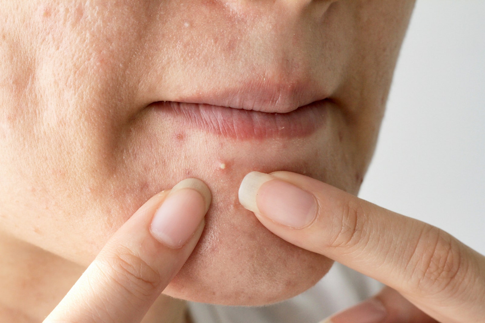 What's the best treatment for pimples?