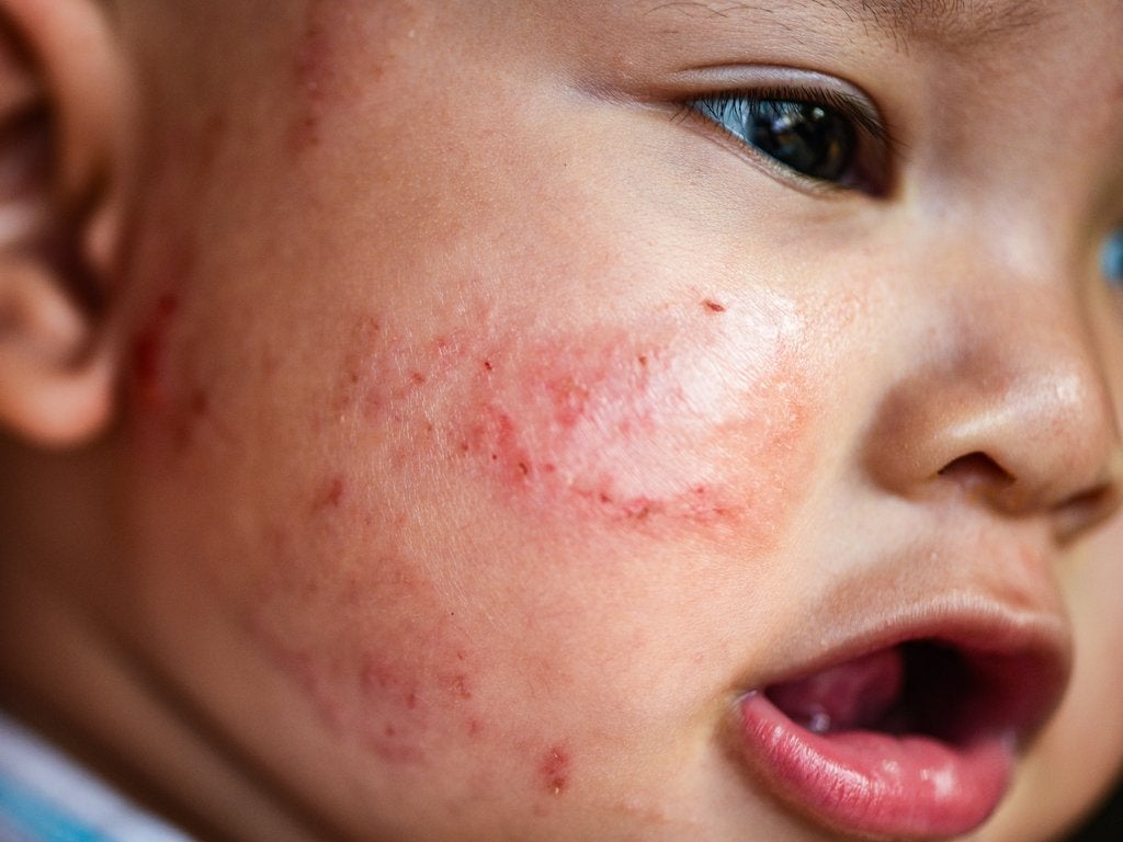 When should you start using eczema treatment for children?