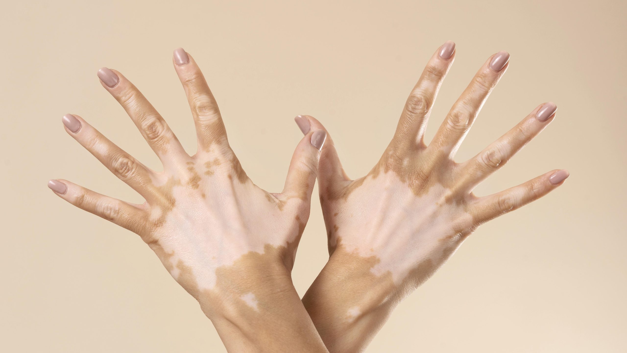 Can Vitiligo Spread From One Person To Another?