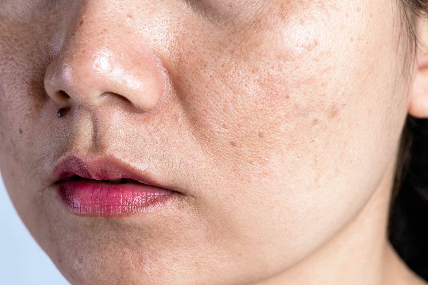 How to reduce pores on the face caused by pimples?