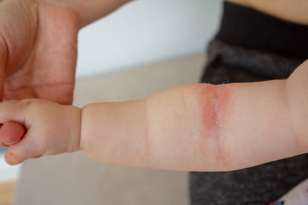 Common Skin Rashes In Children Oho Homeopathy